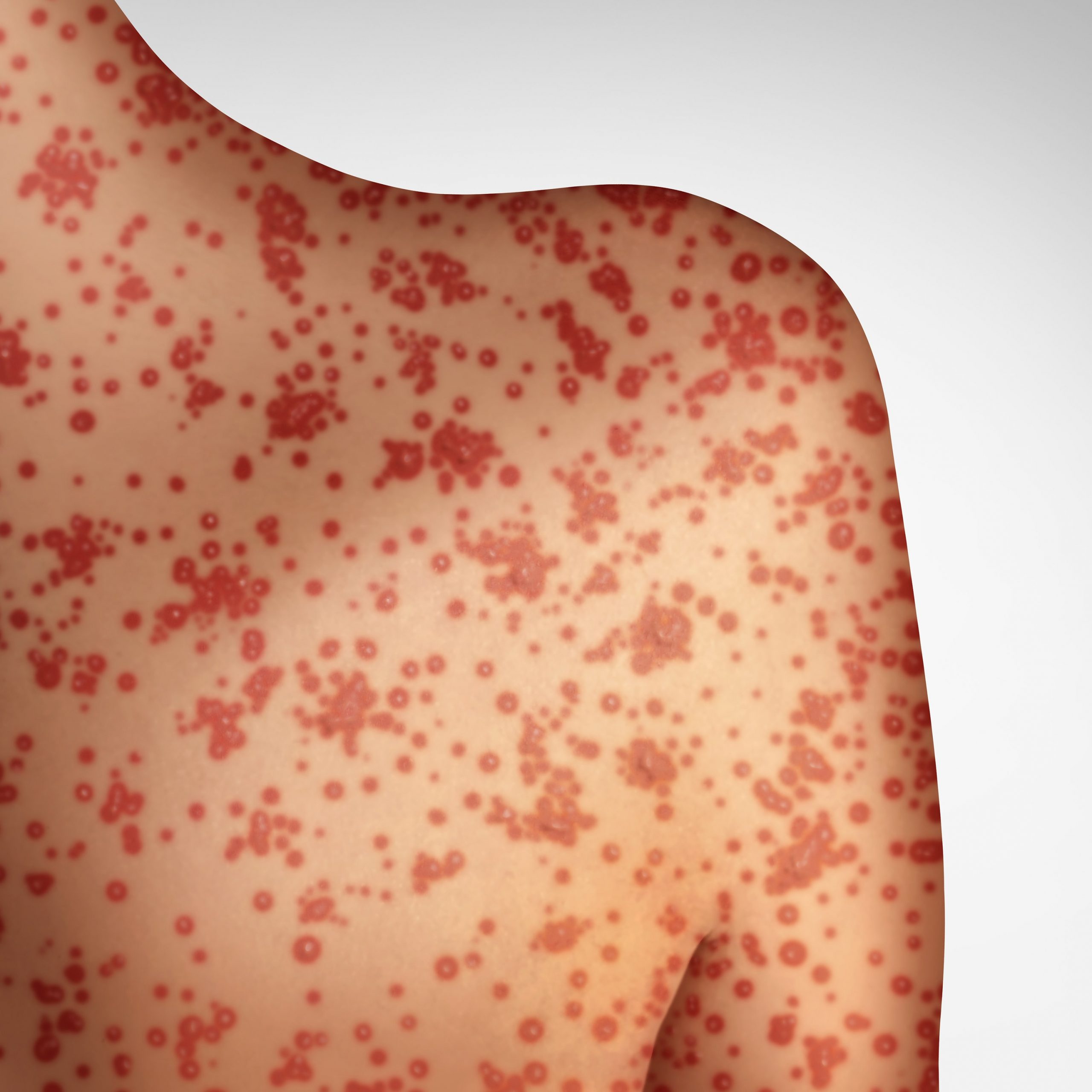 Measles-iStock-scaled.jpg