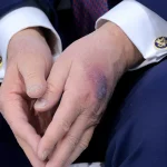 trump-bruise-hand.jpg