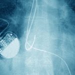 05-HS-pacemaker2-facebookJumbo.jpg
