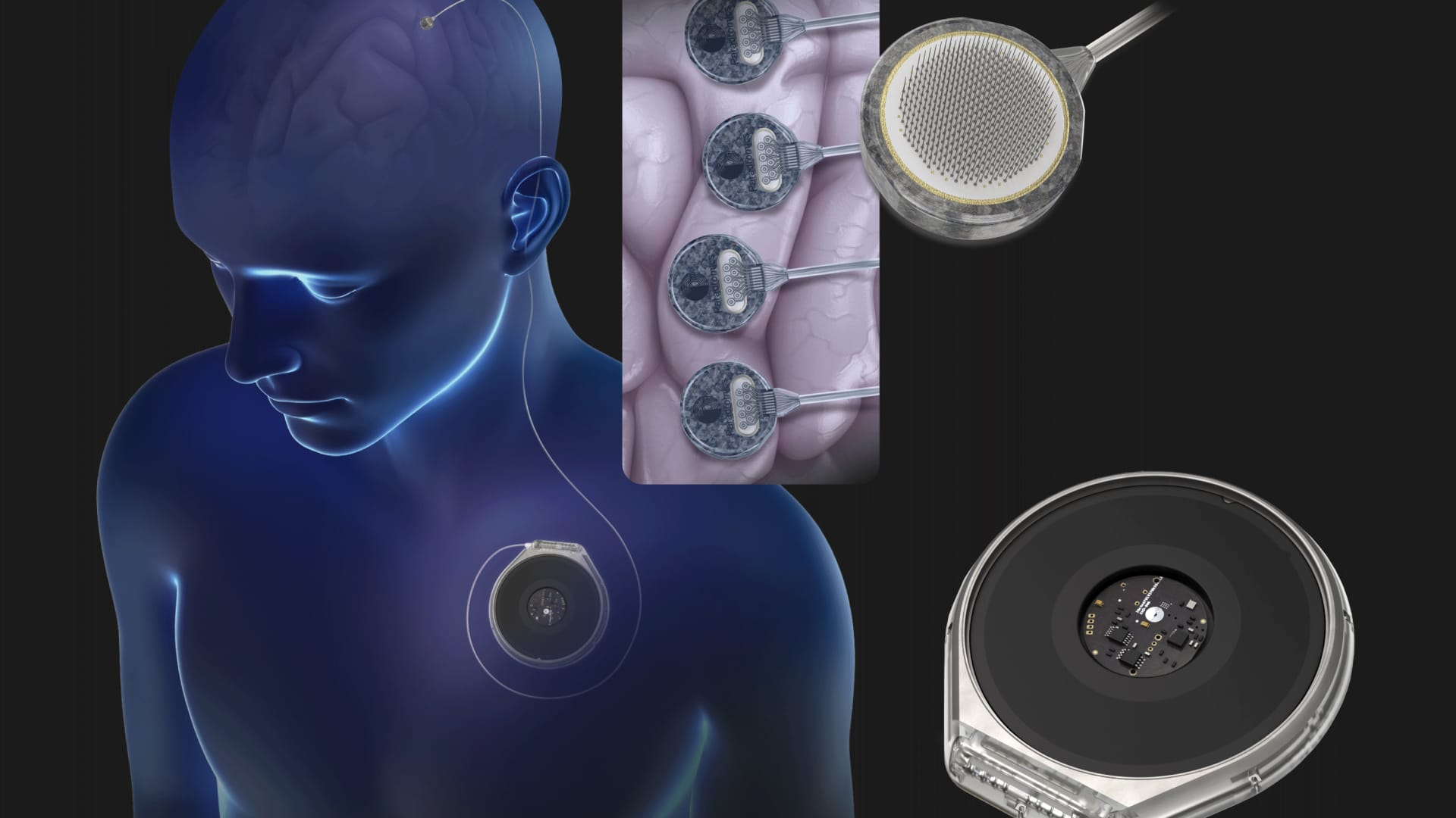 107431586-1718962289235-3_Paradromics_System_Medical_Illustration_2_of_2.png